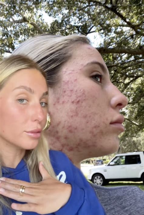 alix earle before accutane|Alix Earle Discusses Acne, Accutane And TikTok。